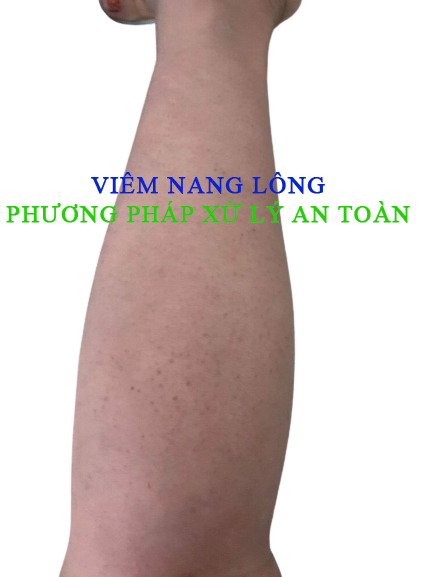 Viên Nang Lông
