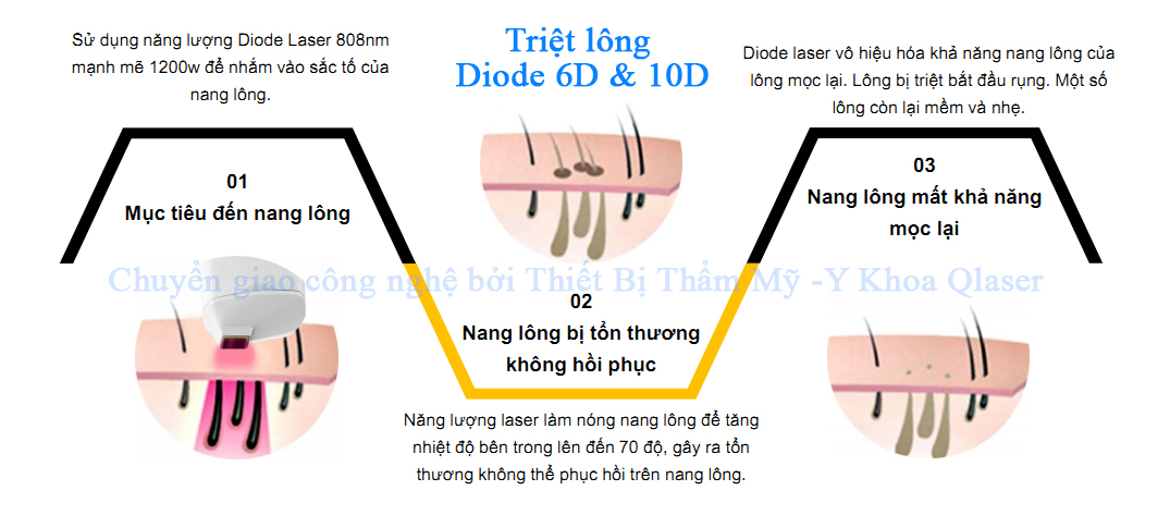 Nguyên lý tác động hiệu quả của máy triệt lông Diode laser